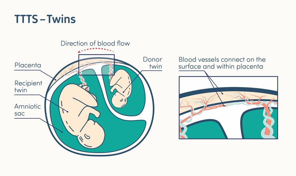 illustration of twin to twin transfusion syndrome in a twin pregnancy