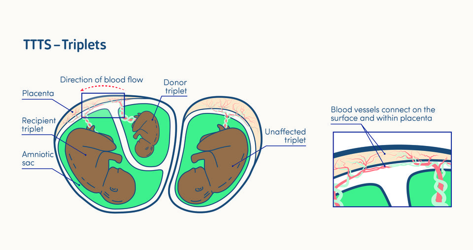 illustration of twin to twin transfusion syndrome in a triplet pregnancy