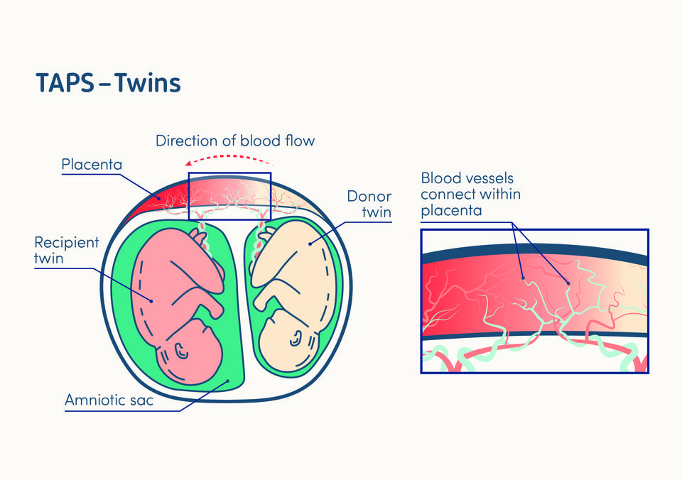 illustration of twin anaemia-polycythaemia sequence in a twin pregnancy