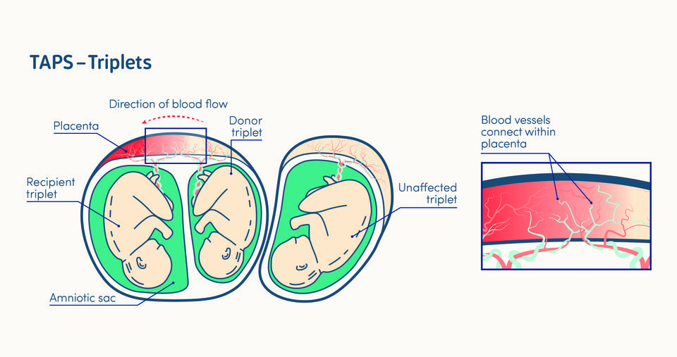 illustration of twin anaemia-polycythaemia sequence in a triplet pregnancy