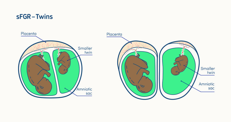 illustration of selective fetal growth restriction in a twin pregnancy