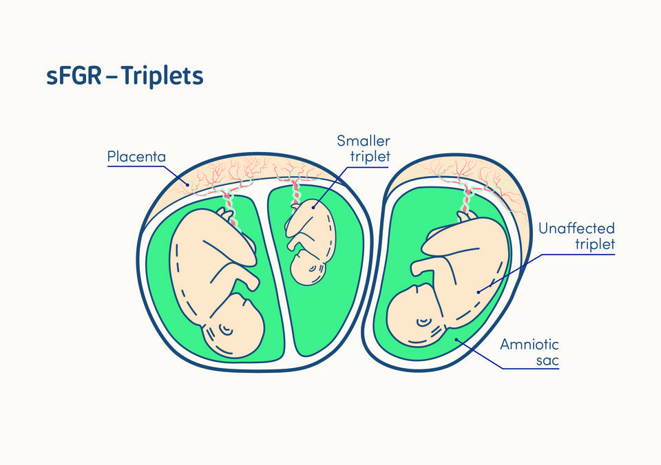 illustration of selective fetal growth restriction in a triplet pregnancy