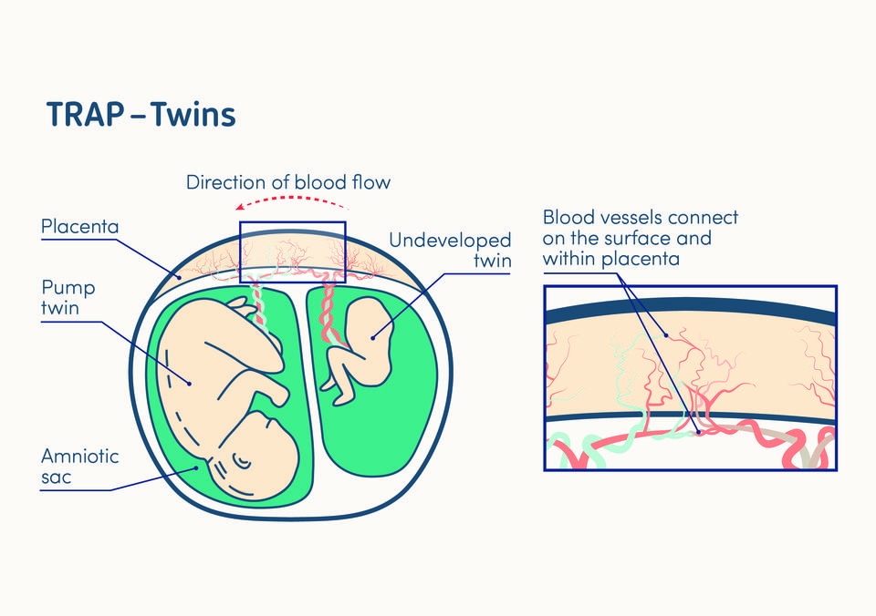 illustration of twin reversed arterial perfusion in a twin pregnancy