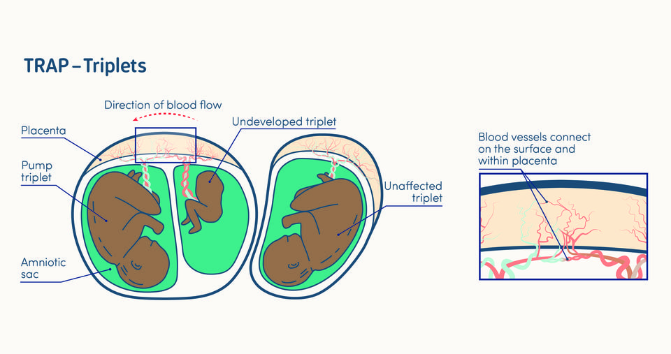 illustration of twin reversed arterial perfusion in a triplet pregnancy