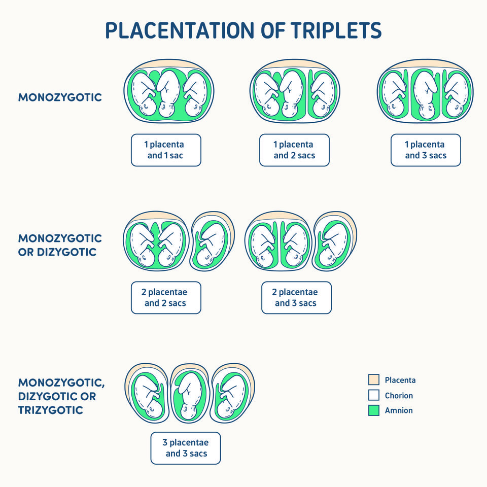 illustration of placentation and zygosity of a triplet pregnancy