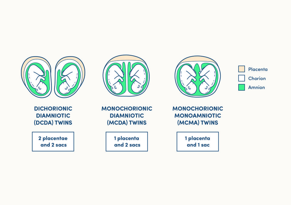 illustration of DCDA, MCDA and MCMA twins