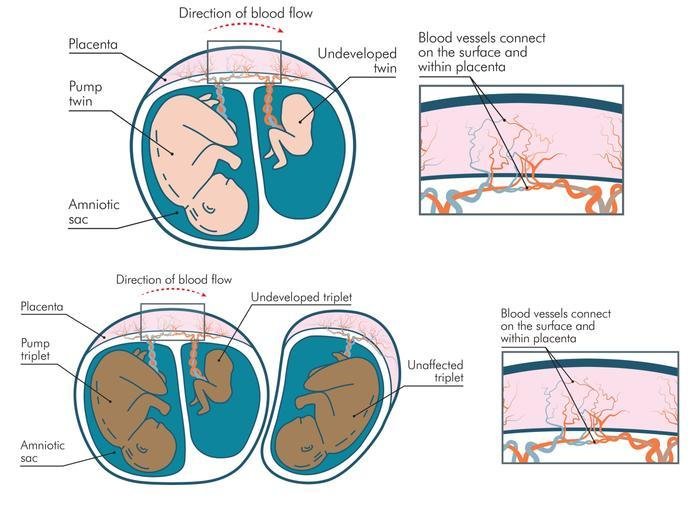 diagram illustrating Twin Reversed Arterial Perfusion Sequence in a twin and triplet pregnancy