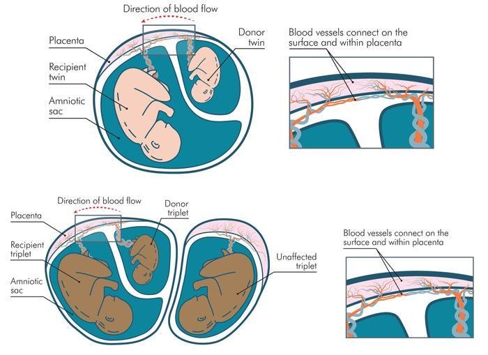 diagram illustrating twin to twin transfusion syndrome in twins and triplets